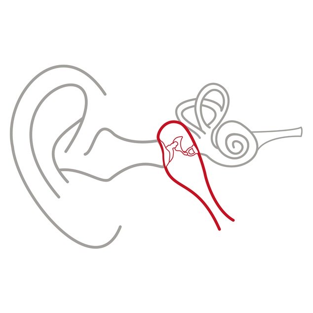 Ilustración del oído externo, el oído medio y el oído interno con el oído medio resaltado en rojo