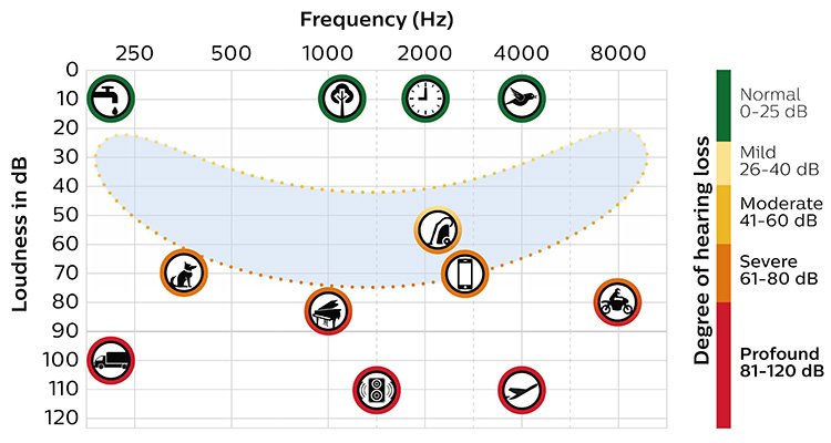 Chart with speech banana shows which sounds are heard at what frequency and loudness level, indicating degree of hearing loss