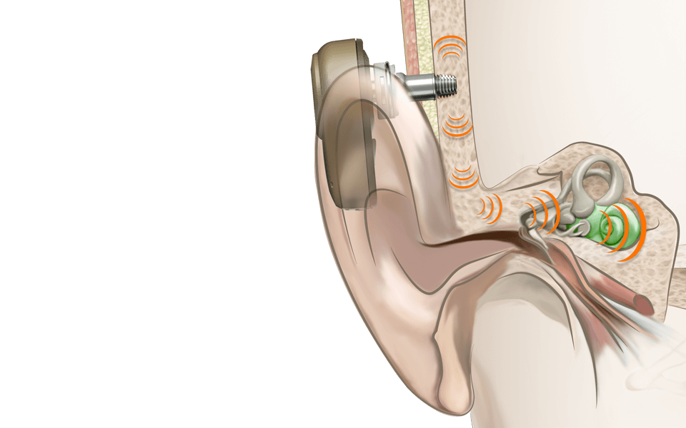 How bone conduction systems work | Oticon Medical