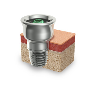 Read more about the well-proven method Brånemark Read more about the Brånemark principle of osseointegration