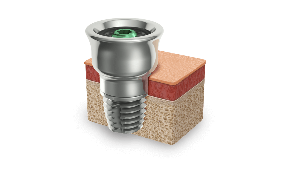 The Ponto implant system is based on the Brånemark principle of osseointegration in which titanium  implants merge with human bone.