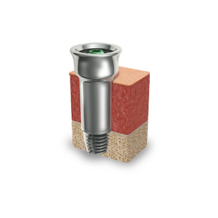 Ponto abutments and tissue preservation surgery improve patient outcomes