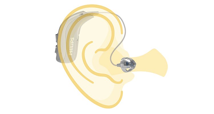 Drawing of an ear with an Philips HearLink behind-the-ear hearing aid showing the exact positioning