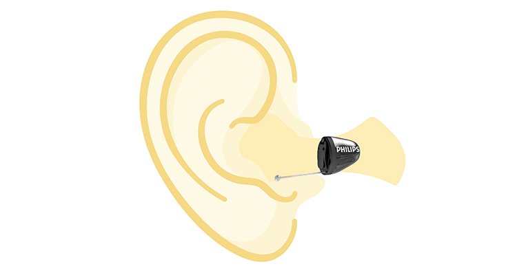 Drawing of an ear with a Philips HearLink in-the-ear hearing aid showing the exact positioning
