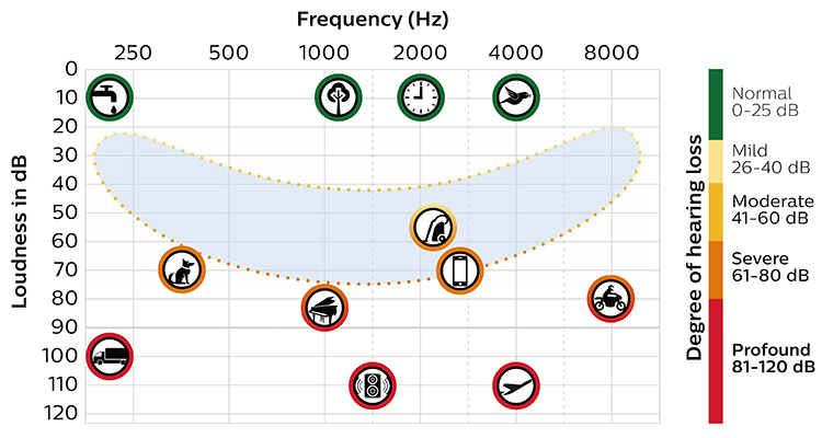 Chart with speech banana shows which sounds are heard at what frequency and loudness level, indicating degree of hearing loss