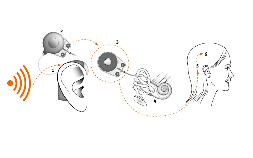 How does a cochlear implant work