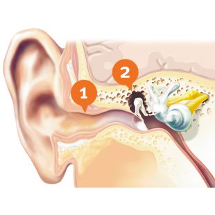 How does conductive hearing loss look like