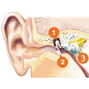 How does mixed hearing loss look like